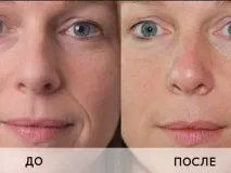 Ін’єкції гіалуронової кислоти (уколи краси) до і після процедури (фото), і скільки буде коштувати єкції