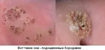 Які бородавки бувають і як визначити ступінь їхньої небезпеки ступінь