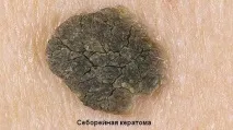 Які бородавки бувають і як визначити ступінь їхньої небезпеки їхньої