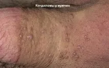 Які бородавки бувають і як визначити ступінь їхньої небезпеки бородавки