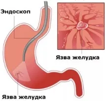 Які антибіотики при виразці шлунка потрібно приймати виразці