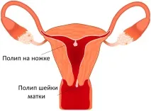 папіломи