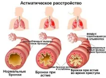 Як правильно лікувати астматичний бронхіт лікувати