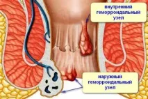 Як вправити геморой в домашніх умовах. умовах