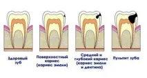 Класифікація пульпітів, різновиди, діагностика, лікування пульпітів
