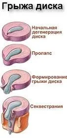 цервикален гръбначен херния
