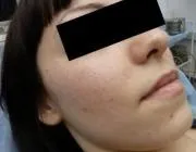 Меланома шкіри, Лазерна терапія, лікування лазером, лазерна терапія в Краснодарі, лікування лазером шкіри