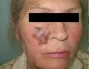 Меланома шкіри, Лазерна терапія, лікування лазером, лазерна терапія в Краснодарі, лікування лазером меланома