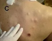 Меланома шкіри, Лазерна терапія, лікування лазером, лазерна терапія в Краснодарі, лікування лазером шкіри