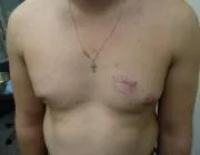 Меланома шкіри, Лазерна терапія, лікування лазером, лазерна терапія в Краснодарі, лікування лазером меланома