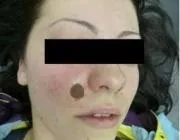 Меланома шкіри, Лазерна терапія, лікування лазером, лазерна терапія в Краснодарі, лікування лазером меланома
