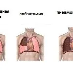 Операція на легенях при раку наслідки видалення раку