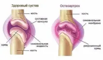 Остеоартроз, що це таке і як лікувати це захворювання остеоартроз