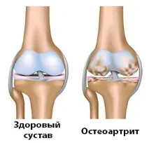 причини остеоартрит