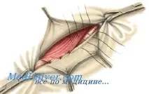 ингвиналния ингвиналния