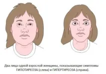 З яких причин може бути підвищено ТТГ у жінок, Щитовидка яких