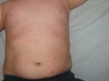 Причини прищів на животі у жінок, чоловіків та дитини прищів