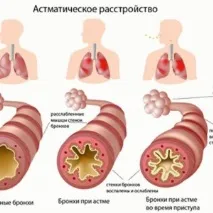 методи бронхиална