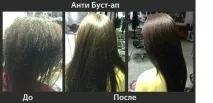 Процедура Буст Ап переваги, недоліки, фото до та після переваги