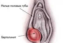 Прищі на статевих губах та лобку у жінок губах