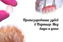 Протезування зубів Ціни, види, в Дедовськ Протезування зубів вінірами, коронками, люмінірами, зубів