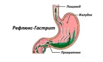 рефлуксният като
