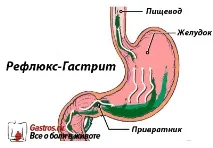 Рефлюкс гастрит лікування, дієта та симптоми рефлюкс