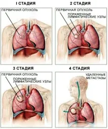 прогноза метастази