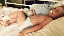 Скільки триває вітрянка скільки днів потрібно бути вдома, скільки днів хворіють і коли закінчуються потрібно