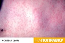 Висип у дитини (фото) висип на обличчі, на тілі, причини висипу. висип