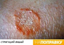 Висип у дитини (фото) висип на обличчі, на тілі, причини висипу. висип