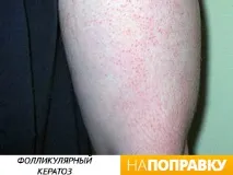 Висип у дитини (фото) висип на обличчі, на тілі, причини висипу. висип