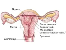 поліпів