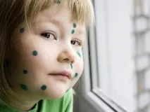 Скільки триває вітрянка скільки днів потрібно бути вдома, скільки днів хворіють і коли закінчуються триває
