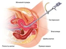 поліпів