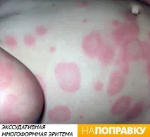 Висип у дитини (фото) висип на обличчі, на тілі, причини висипу. фото