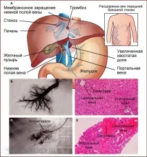 печінки