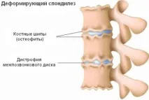 Спондильоз хребта (поперековий, шийний, крижовий) – лікування спондильоз