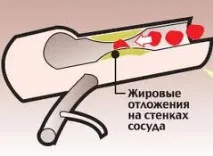 съдова стеноза