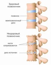 Спондильоз хребта (поперековий, шийний, крижовий) – лікування шийний