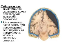 лечение хематом