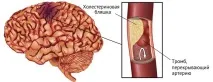 инсулти инсулти