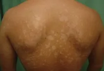 хапчета кожата
