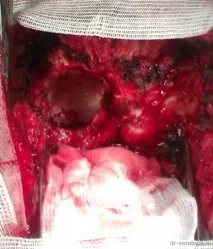 Видалення менінгіоми лівої гемісфери мозочка, Нейрохірургія видалення