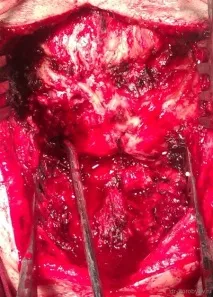 Видалення менінгіоми лівої гемісфери мозочка, Нейрохірургія видалення