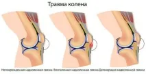 коляно коляно