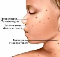 Види висипу при різних формах вітрянки, способи лікування висипу
