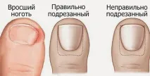нокът
