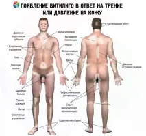 симптоми витилиго