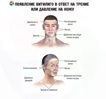 витилиго симптоми